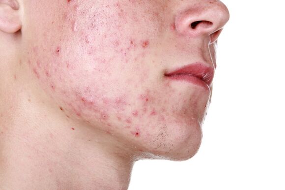 Kožní léze na obličeji s demodikózou